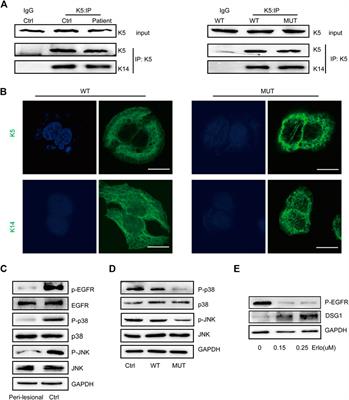 Damaged Keratin Filament Network Caused by KRT5 Mutations in Localized Recessive Epidermolysis Bullosa Simplex